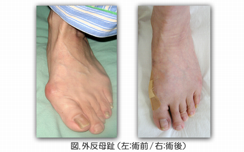 orthopedics_foot_02