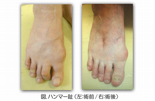 orthopedics_foot_03
